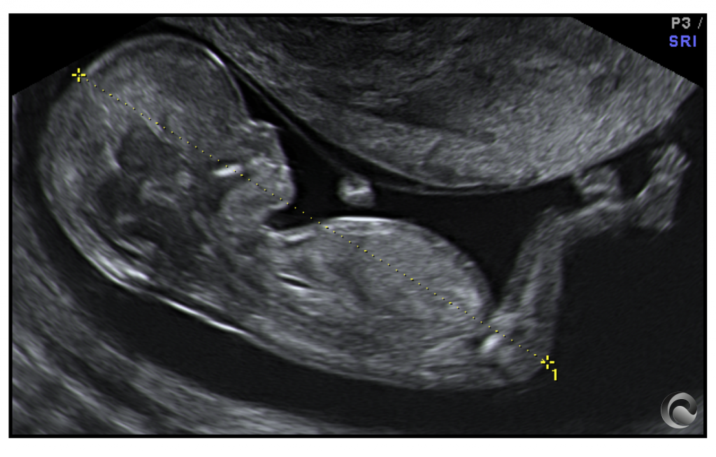 Longitud cefalo-nalga fetal